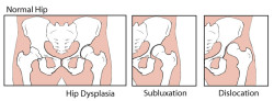 Normal Hip